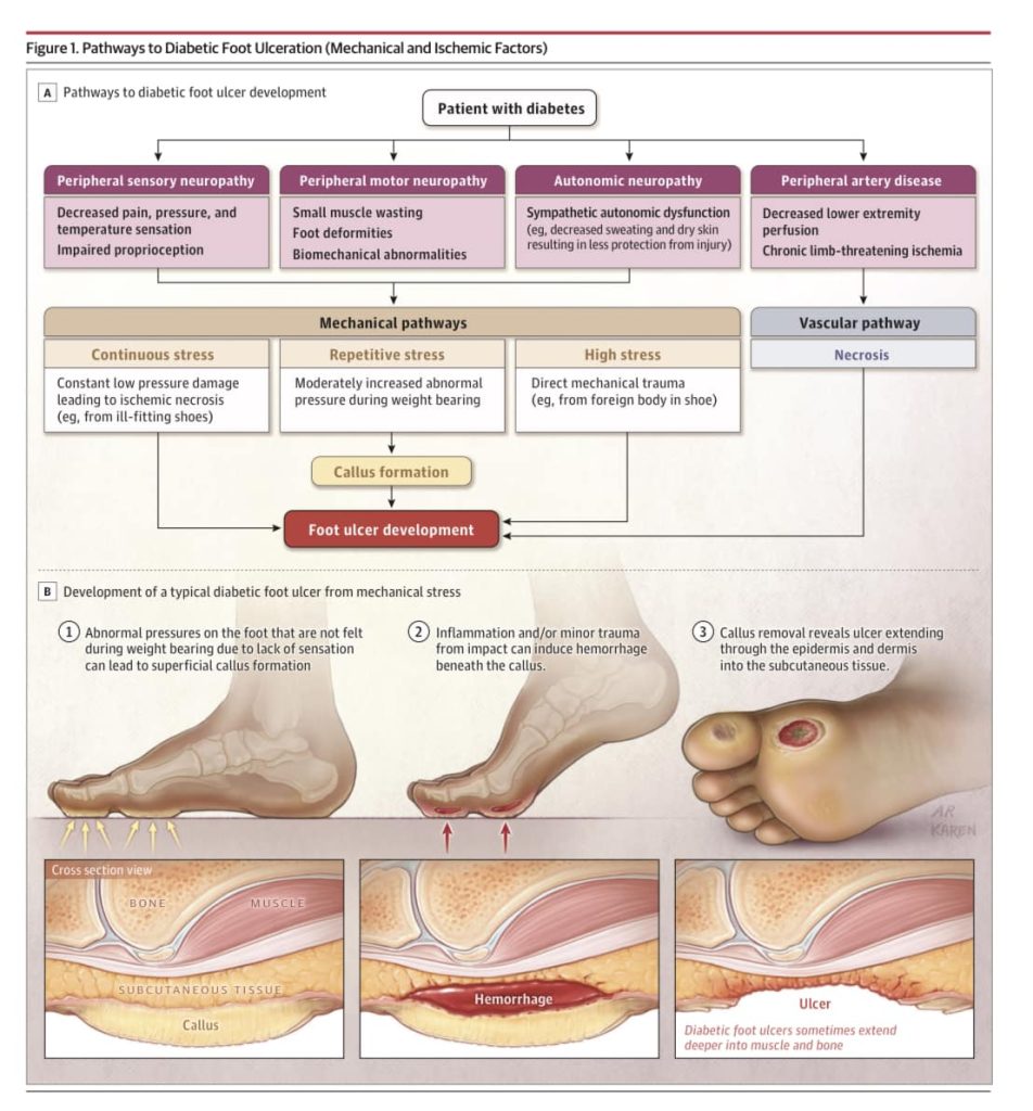 Diabetic foot ulcers are a common and serious complication of diabetes, characterized by open sores or wounds on the feet that can result from a combination of factors, including neuropathy, poor circulation, and infection. These ulcers can lead to significant morbidity, including infections, gangrene, and even amputations if not managed properly.