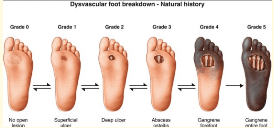 Diabetic foot ulcers are a common and serious complication of diabetes, characterized by open sores or wounds on the feet that can result from a combination of factors, including neuropathy, poor circulation, and infection. These ulcers can lead to significant morbidity, including infections, gangrene, and even amputations if not managed properly.