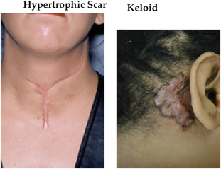 Hypertrophic scars (HPTS) are raised, thickened areas of skin that develop as a result of an overproduction of collagen during the wound healing process. They typically occur after an injury, surgery, or burns and are characterized by their red or purple color, firmness, and elevated texture compared to the surrounding skin. Unlike keloid scars, hypertrophic scars remain confined to the boundaries of the original wound and may improve over time.