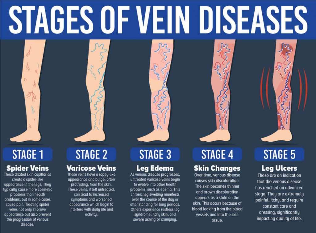 Venous ulcers, also known as venous stasis ulcers, are chronic wounds that occur primarily on the lower legs due to improper functioning of the venous system. They are a common complication of chronic venous insufficiency (CVI), where veins fail to adequately return blood from the legs to the heart, leading to increased pressure in the veins and subsequent skin breakdown.