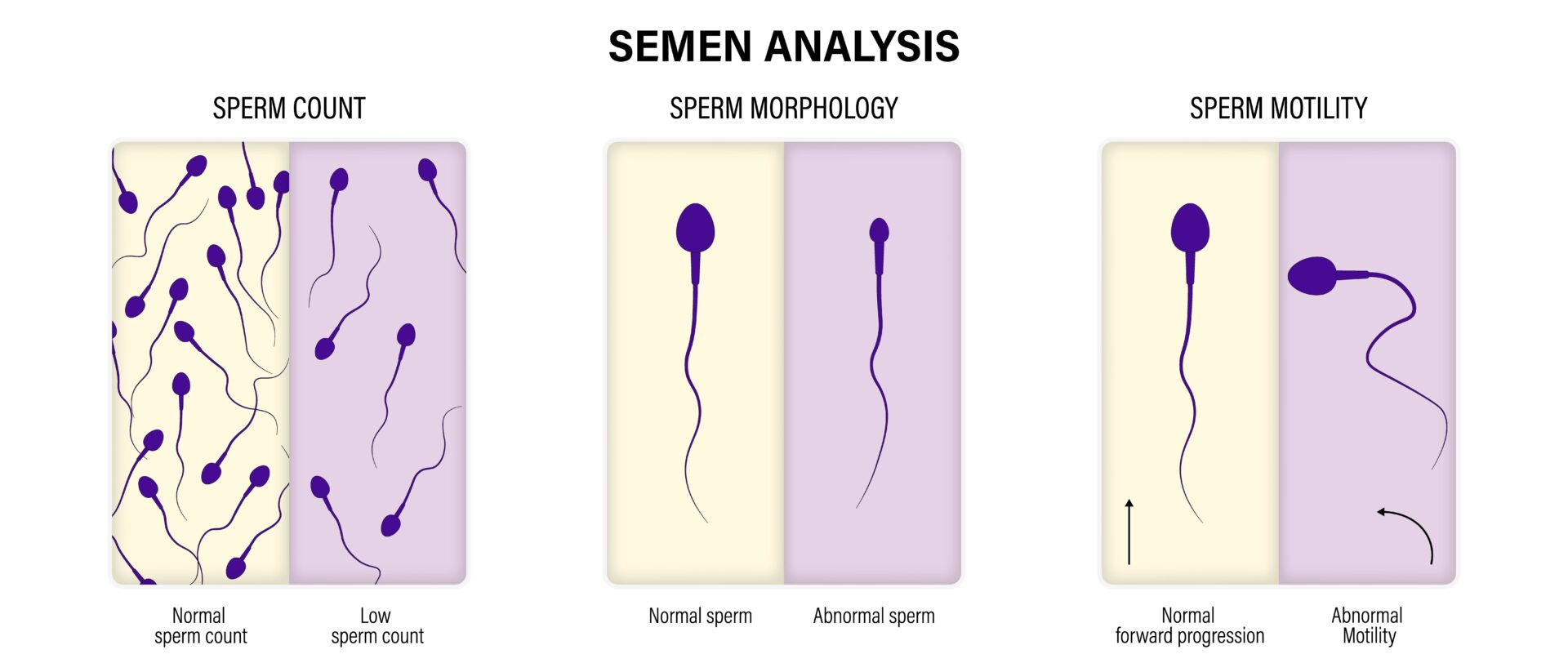 Semen analysis, also known as sperm analysis or semen evaluation, is a laboratory test that assesses the quality and quantity of a man's semen and sperm. This test is essential for evaluating male fertility and diagnosing potential reproductive issues.