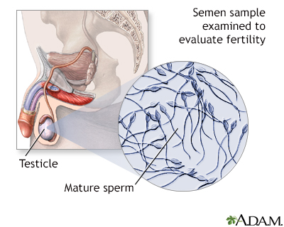 Semen analysis, also known as sperm analysis or semen evaluation, is a laboratory test that assesses the quality and quantity of a man's semen and sperm. This test is essential for evaluating male fertility and diagnosing potential reproductive issues.