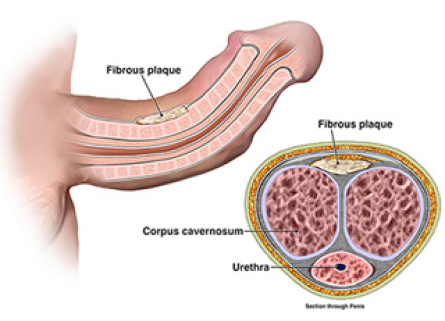 Peyronie’s Disease (PD): Affects 3–9% of men, causing abnormal curvature of the penis due to fibrous scar tissue, resulting in pain, erectile difficulties, and psychological distress.
