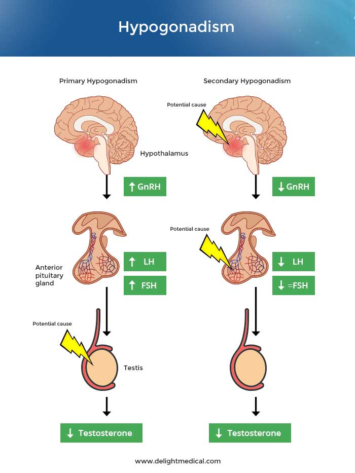 Hypogonadism: Occurs when the testes fail to produce adequate testosterone, leading to reduced muscle mass, infertility, and sexual dysfunction, affecting up to 5% of men.