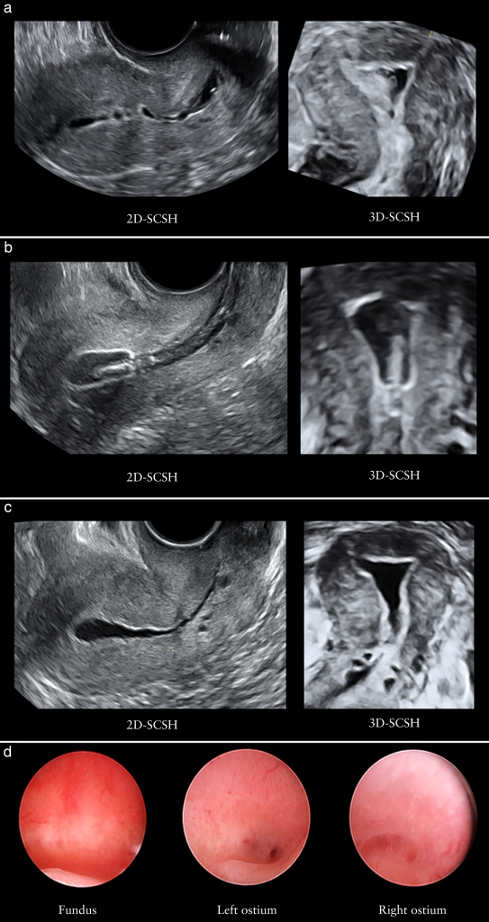 Patients with intrauterine adhesions observed significant endometrial thickening and functional recovery, resulting in a 50-70% increase in pregnancy rates following Cellular Therapy and Stem Cells for Male and Female Reproductive Organ Diseas interventions at DrStemCellsThailand's Anti-Aging and Regenerative Medicine Center of Thailand.