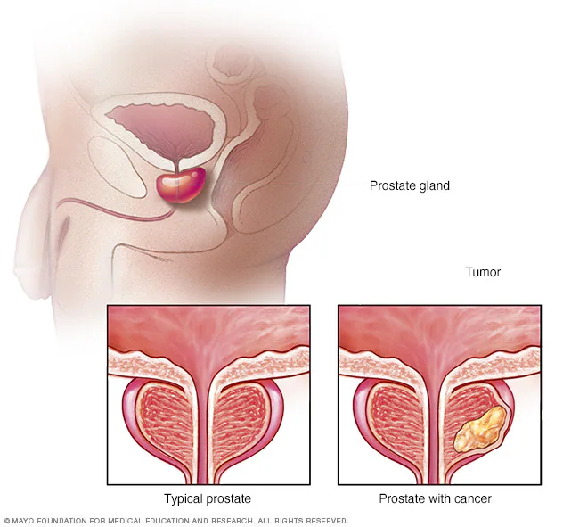 Prostate Cancer (Post-Surgery or Radiation Therapy): The second most common cancer in men, often requiring surgery or radiation, leading to side effects such as erectile dysfunction, urinary incontinence, and reduced quality of life  [16-20].