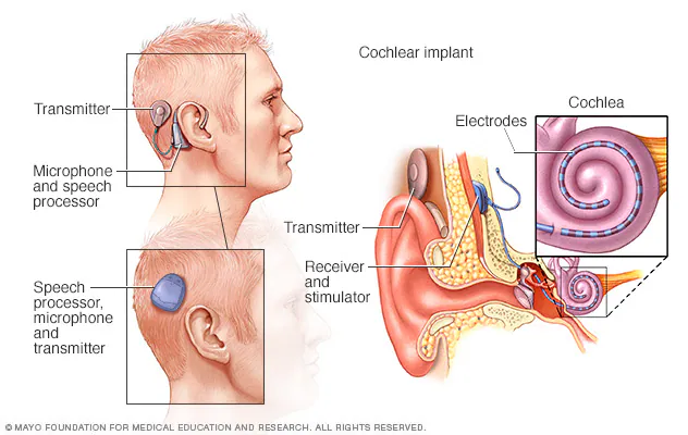 A cochlear implant is a surgically implanted electronic device designed to provide a sense of sound to individuals with moderate to profound sensorineural hearing loss. Unlike hearing aids, which amplify sound, cochlear implants bypass damaged portions of the ear and directly stimulate the auditory nerve.