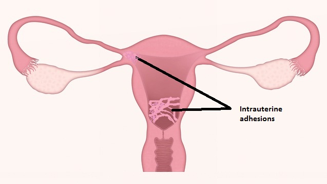 Asherman’s Syndrome (Intrauterine Adhesions): Occurs in 1.5% of women undergoing dilation and curettage procedures, leading to scarring in the uterine cavity, menstrual irregularities, and infertility.