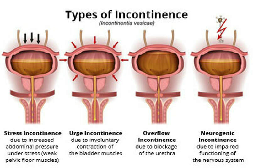 Urinary dysfunction encompasses a range of conditions that affect the ability to store or eliminate urine effectively. These conditions can significantly impact quality of life and may arise from various underlying causes, including anatomical abnormalities, neurological disorders, infections, and chronic diseases. Understanding urinary dysfunction is essential for effective diagnosis and treatment.