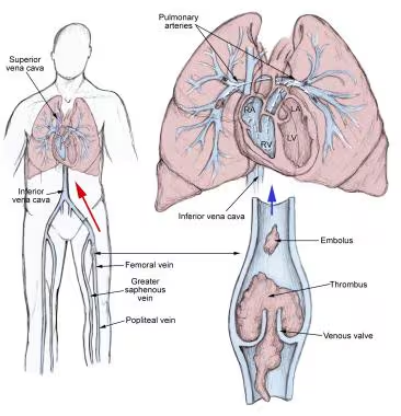 Pulmonary embolism (PE) is a serious condition characterized by the occlusion of pulmonary arteries, typically caused by thrombi that originate from the deep veins of the legs or pelvis. This blockage can lead to significant respiratory and cardiovascular complications, making timely diagnosis and treatment crucial.