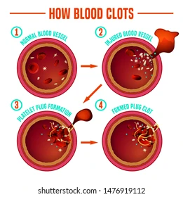 Clotting factors are proteins found in blood plasma that play a crucial role in the coagulation process, which prevents excessive bleeding following vascular injury. These factors work together in a complex cascade known as the coagulation cascade, leading to the formation of a stable blood clot.