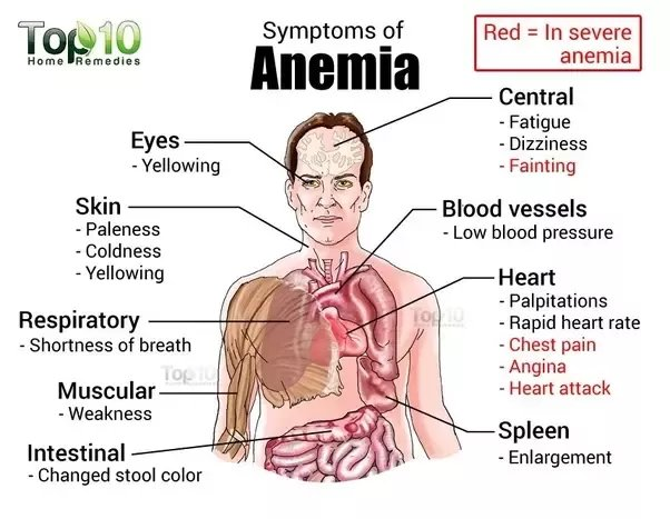 Anemia is a condition characterized by a decrease in the number of red blood cells (RBCs) or a lower than normal concentration of hemoglobin within those cells. Hemoglobin is essential for transporting oxygen throughout the body, and insufficient levels can lead to a decreased capacity for oxygen delivery to tissues. This results in symptoms such as fatigue, weakness, dizziness, and shortness of breath.