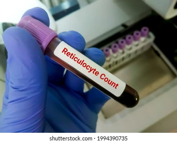 A reticulocyte count (RC) is a blood test that measures the number of reticulocytes, which are immature red blood cells, in the bloodstream. This test helps assess how well the bone marrow is producing new red blood cells, providing valuable information about a person's hematologic health.