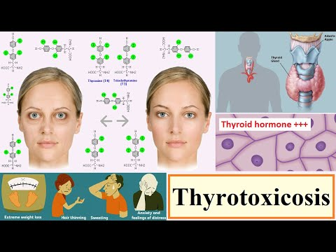 Thyrotoxicosis is a medical condition characterized by an excessive amount of thyroid hormones in the bloodstream, leading to a hypermetabolic state. This condition can result from various causes, including hyperthyroidism, thyroiditis, and excessive intake of thyroid hormones.