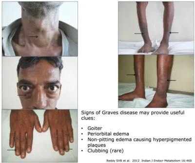 Thyroid storm (TS), also known as thyroid crisis, is a rare but severe and life-threatening complication of hyperthyroidism. It occurs when an overactive thyroid gland leads to extreme hypermetabolism, causing a cascade of systemic effects that can result in cardiac arrest or multiple organ failure if not promptly treated.