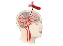 Tissue plasminogen activator (tPA) is a serine protease enzyme that plays a crucial role in the breakdown of blood clots by converting plasminogen into plasmin, the primary enzyme responsible for clot dissolution. This process is essential for maintaining vascular health and preventing thrombotic events.