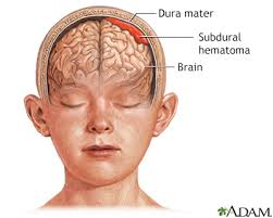 Increased intracranial pressure (ICP) refers to elevated pressure within the skull, which can be life-threatening if not promptly addressed. This condition often results from an excess of cerebrospinal fluid, brain swelling, or other causes that increase pressure on the brain.