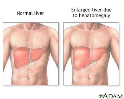 Hepatosplenomegaly is a medical term used to describe the simultaneous enlargement of both the liver (hepatomegaly) and spleen (splenomegaly). This condition can be indicative of various underlying health issues and can occur in both acute and chronic settings.