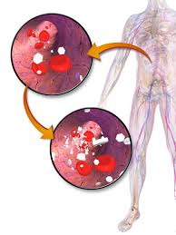 Hyperglycemia, or high blood sugar, is a condition where glucose levels in the blood exceed normal limits. It is commonly associated with diabetes mellitus but can also occur in non-diabetic individuals due to various factors.