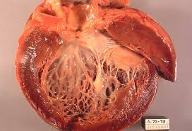 Cardiomyopathy is a disease of the heart muscle that makes it harder for the heart to pump blood to the rest of the body1. It encompasses a collection of diverse conditions with many causes, symptoms, and treatments, affecting people of all ages and races2. In most cases, the heart muscle becomes enlarged, thick, or rigid1. In rare instances, diseased heart muscle tissue is replaced with scar tissue1.