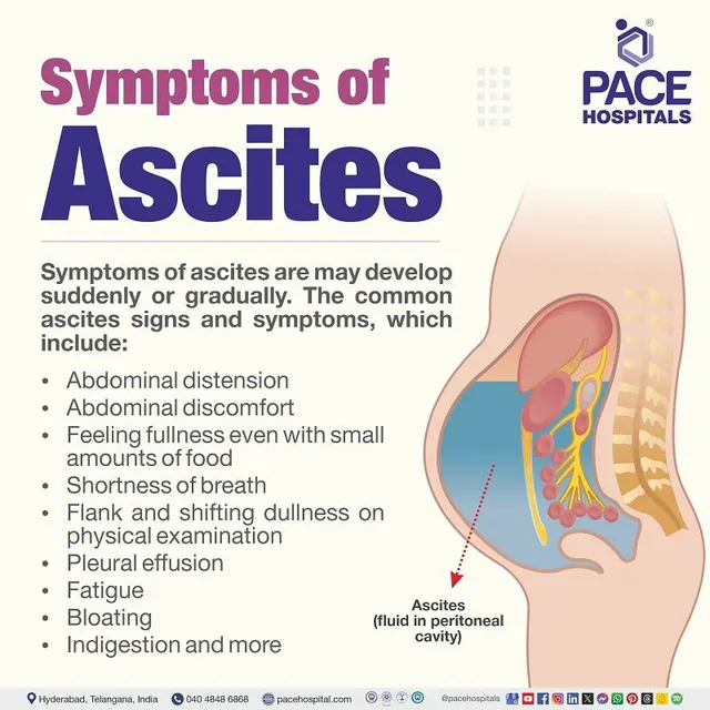 Ascites is the pathological accumulation of fluid within the peritoneal cavity, the space between the abdominal lining and the internal abdominal organs. It is a common complication of various underlying medical conditions, particularly liver disease.