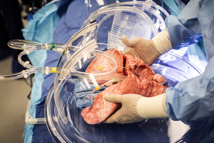 Lung transplantation is a surgical procedure to replace a diseased or failing lung with a healthy lung, usually from a deceased donor. It is a treatment option for end-stage respiratory failure when other treatments have not worked.