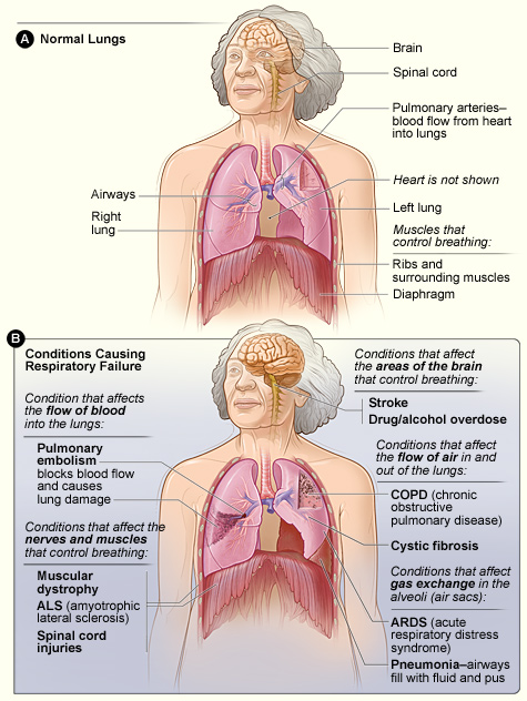 Respiratory failure occurs when the lungs can't efficiently exchange oxygen and carbon dioxide, leading to abnormal levels of these gases in the blood. It's defined by the arterial oxygen, carbon dioxide, or both not being maintained at normal levels. A drop in oxygen is hypoxemia, while a rise in carbon dioxide is hypercapnia. This condition can be acute, developing suddenly, or chronic, developing over time. Respiratory failure often requires immediate medical attention.