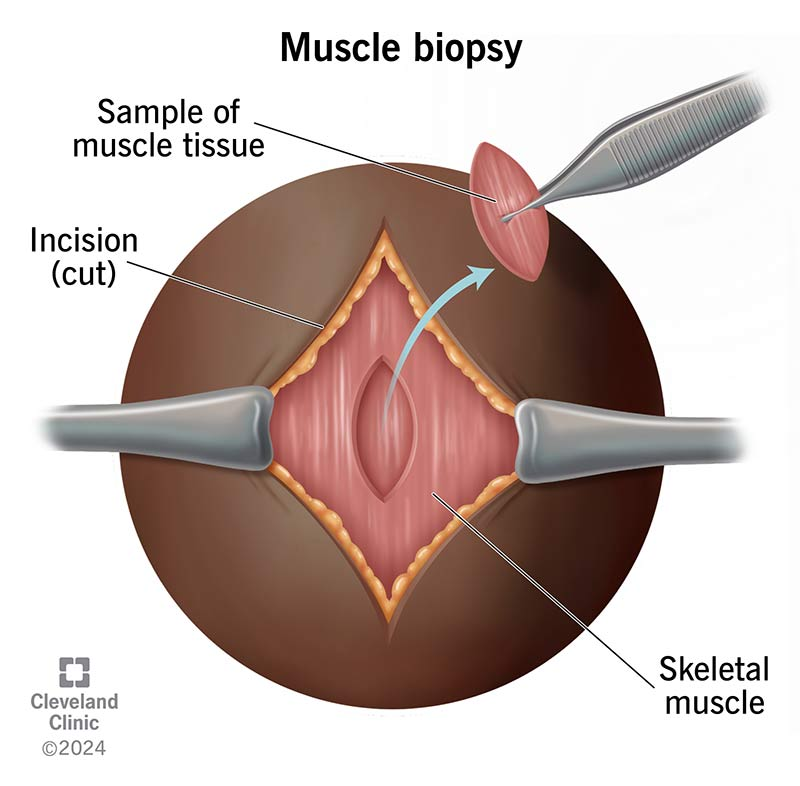 A muscle biopsy is a diagnostic procedure that involves the removal of a small piece of muscle tissue for microscopic examination[3]. It is a valuable tool for diagnosing various neuromuscular disorders, including muscular dystrophy, inflammatory myopathies, metabolic myopathies, and other conditions affecting muscle function[6][4]. The choice of muscle for biopsy depends on the suspected condition and the location of symptoms, but common sites include the biceps (upper arm), deltoid (shoulder), or quadriceps (thigh)[4].