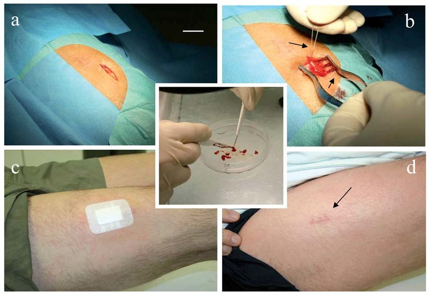 A muscle biopsy is a diagnostic procedure that involves the removal of a small piece of muscle tissue for microscopic examination[3]. It is a valuable tool for diagnosing various neuromuscular disorders, including muscular dystrophy, inflammatory myopathies, metabolic myopathies, and other conditions affecting muscle function[6][4]. The choice of muscle for biopsy depends on the suspected condition and the location of symptoms, but common sites include the biceps (upper arm), deltoid (shoulder), or quadriceps (thigh)[4].