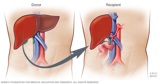 A liver transplant is a surgical procedure that involves replacing a diseased or failing liver with a healthy liver from a donor. This operation is typically performed on patients with end-stage liver disease, liver failure, or certain types of liver cancer.