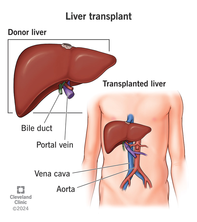 A liver transplant is a surgical procedure that involves replacing a diseased or failing liver with a healthy liver from a donor. This operation is typically performed on patients with end-stage liver disease, liver failure, or certain types of liver cancer.