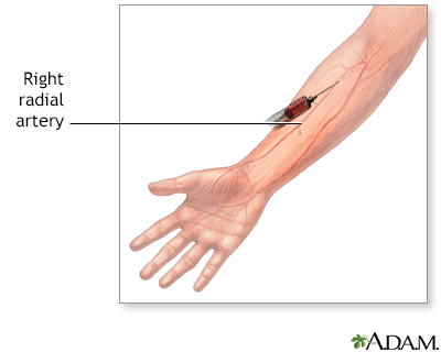 An arterial blood gas (ABG) test is a crucial diagnostic procedure used to measure the levels of oxygen and carbon dioxide in arterial blood, as well as the blood's pH balance[1][4][2]. Unlike a blood gas analysis that can use blood from any part of the circulatory system, an ABG specifically requires a sample drawn from an artery[4]. This test provides valuable information about a patient's ventilation, gas exchange, and acid-base status[5]. ABGs are commonly performed in intensive care units and emergency settings to quickly assess and manage critical illnesses[1][4].