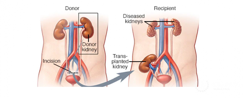 A kidney transplant is a surgical procedure that involves replacing a failing or damaged kidney with a healthy kidney from a living or deceased donor. This procedure is often the best treatment option for individuals suffering from end-stage renal disease (ESRD) or chronic kidney failure, as it can significantly improve quality of life and restore kidney function. The surgery typically takes 3 to 4 hours and is performed under general anesthesia, allowing the new kidney to be implanted in the lower abdomen without removing the existing kidneys unless they are causing complications.