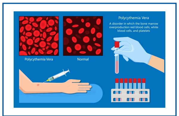 Polycythemia is a blood disorder characterized by an increased number of red blood cells (RBCs) in the body. This condition leads to thicker blood, which can slow circulation and increase the risk of complications such as blood clots, strokes, and heart attacks. Polycythemia can be classified into two main types: primary polycythemia (polycythemia vera) and secondary polycythemia.