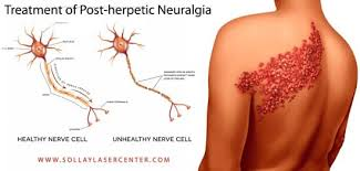 Postherpetic neuralgia (PHN) or Shingles is a painful condition that occurs as a complication of shingles (herpes zoster), which is caused by the reactivation of the varicella zoster virus. PHN is characterized by persistent nerve pain in the area where the shingles rash appeared, lasting for at least 90 days after the rash has healed.