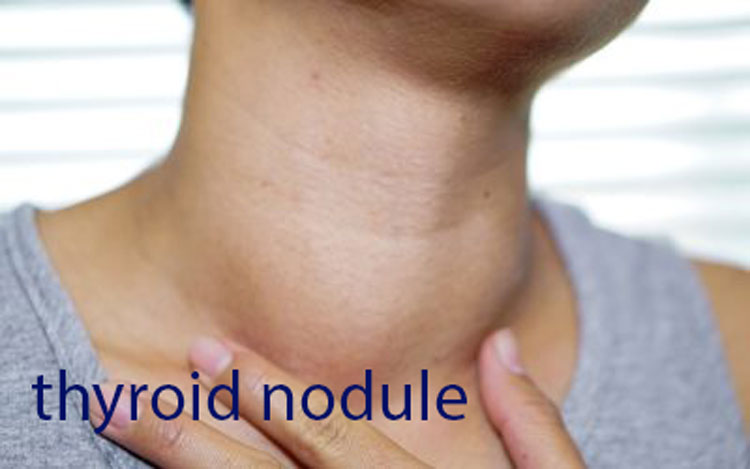 Thyroid nodules are abnormal growths of thyroid tissue that can form within the thyroid gland, located in the front of the neck. While these nodules are common and often benign, understanding their characteristics, potential risks, and management strategies is essential for maintaining thyroid health.