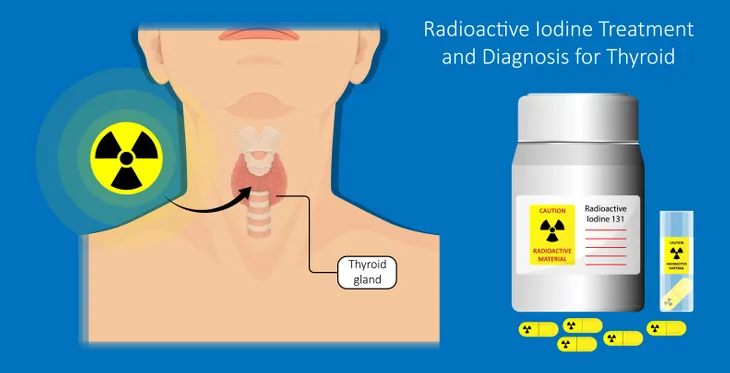 Radioactive iodine therapy (RIT), specifically using iodine-131 (I-131), is a widely accepted treatment for hyperthyroidism, a condition characterized by excessive thyroid hormone production. This therapy effectively reduces thyroid function and alleviates symptoms associated with hyperthyroidism.