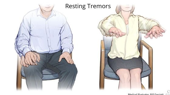 Tremors (TMR) are involuntary, rhythmic movements of one or more parts of the body, most commonly affecting the hands. They can be caused by a variety of factors, ranging from neurological disorders to lifestyle influences.