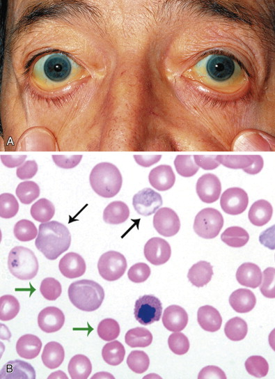 Hemolysis refers to the breakdown or destruction of red blood cells (RBCs), leading to the release of hemoglobin and other intracellular components, such as potassium, lactate dehydrogenase (LDH), and aspartate aminotransferase (AST), into the bloodstream or plasma. This process can occur due to pathological conditions, autoimmune diseases, infections, hereditary disorders, or external factors such as improper sample handling during laboratory testing. Hemolysis can interfere with diagnostic accuracy by causing falsely elevated or decreased levels of various analytes in laboratory tests. For example, potassium levels may appear significantly higher due to its high intracellular concentration, while sodium and glucose levels may be falsely reduced due to dilutional effects. Additionally, hemoglobin released during hemolysis can interfere with spectrophotometric measurements by absorbing light at specific wavelengths, further complicating test results. These interferences can lead to misdiagnosis or inappropriate treatment decisions, making hemolysis a critical consideration in clinical laboratory medicine.