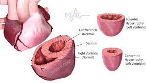 Left Ventricular Hypertrophy (LVH) is a condition where the muscle wall of the left ventricle, the heart's main pumping chamber, becomes thicker and enlarged. This thickening often occurs in response to conditions that increase the workload on the heart, such as high blood pressure or heart valve problems.