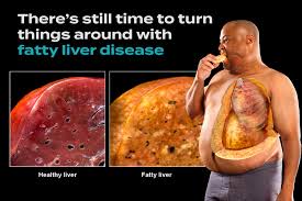 Fatty Liver Disease (Steatosis), also known as hepatic steatosis or steatotic liver disease (SLD), is a common condition characterized by the accumulation of excess fat in the liver cells238. There are two main types5: