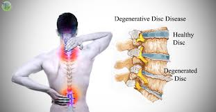 Disc degeneration, also known as degenerative disc disease, is a condition where the intervertebral discs in the spine deteriorate over time. This process can lead to pain, stiffness, and reduced mobility.