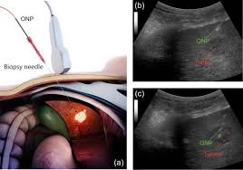 Liver Biopsy (LBx) is a diagnostic procedure used to determine the cause or extent of liver injury. It involves removing a small tissue sample from the liver for examination under a microscope14. Liver biopsies help diagnose liver diseases like cirrhosis, autoimmune hepatitis, fatty liver disease, Wilson’s disease, and hepatitis B or C, determine the stage of liver disease, monitor the liver after a transplant, create a treatment plan, and take a tissue sample from an abnormality1.