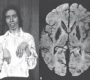 Wilson's disease is a rare genetic disorder characterized by the excessive accumulation of copper in the body, particularly in the liver, brain, and eyes38. This buildup can lead to a variety of symptoms affecting these organs and others6.