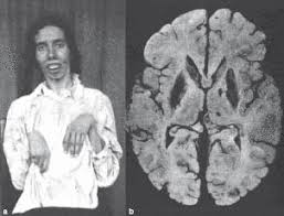 Wilson's disease is a rare genetic disorder characterized by the excessive accumulation of copper in the body, particularly in the liver, brain, and eyes38. This buildup can lead to a variety of symptoms affecting these organs and others6.