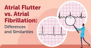 Atrial fibrillation (AF) is a common heart rhythm disorder characterized by irregular and rapid heartbeats originating in the atria, the upper chambers of the heart. This irregular electrical activity can lead to various complications, including stroke, heart failure, and diminished quality of life12. Managing AF involves a combination of lifestyle modifications, medications, and, in some cases, interventional procedures aimed at restoring a normal heart rhythm and preventing thromboembolic events3.