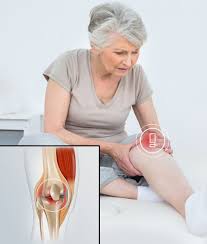 Knee osteoarthritis (OA) is a degenerative condition characterized by the gradual breakdown of cartilage in the knee joint, leading to pain, stiffness, and reduced function23. It is the most common form of arthritis in the knee, often resulting from age-related wear and tear, though injuries or other factors can also contribute12. While there is no cure, various treatments can manage symptoms and slow the condition's progression23.