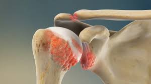 Shoulder osteoarthritis (OA) is a degenerative joint condition characterized by the breakdown of cartilage in the shoulder joint, leading to pain, stiffness, and reduced range of motion36. While shoulders are less susceptible to wear and tear compared to weight-bearing joints, longer lifespans and increased sports participation have contributed to rising numbers of shoulder problems earlier in life3.