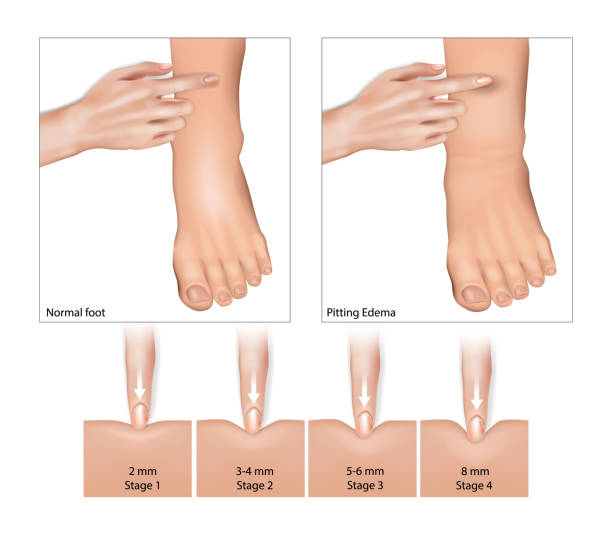 Edema is a condition characterized by swelling due to fluid accumulation in bodily tissues. It can occur in various parts of the body, most commonly affecting the legs, feet, and ankles, but also the hands, face, and other areas.