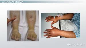 Edema (Edm) is a condition characterized by swelling due to fluid accumulation in bodily tissues. It can occur in various parts of the body, most commonly affecting the legs, feet, and ankles, but also the hands, face, and other areas.